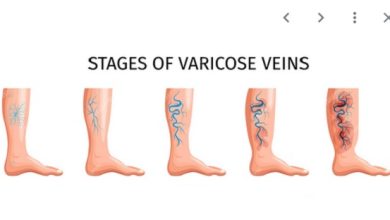 انواع زخم تروفیک کدامند