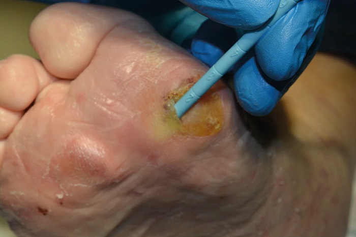 ترشح چرکی زخم و علائم آن