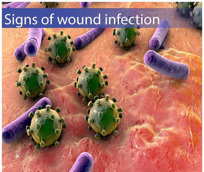 عفونت بخیه چگونه درمان میشود