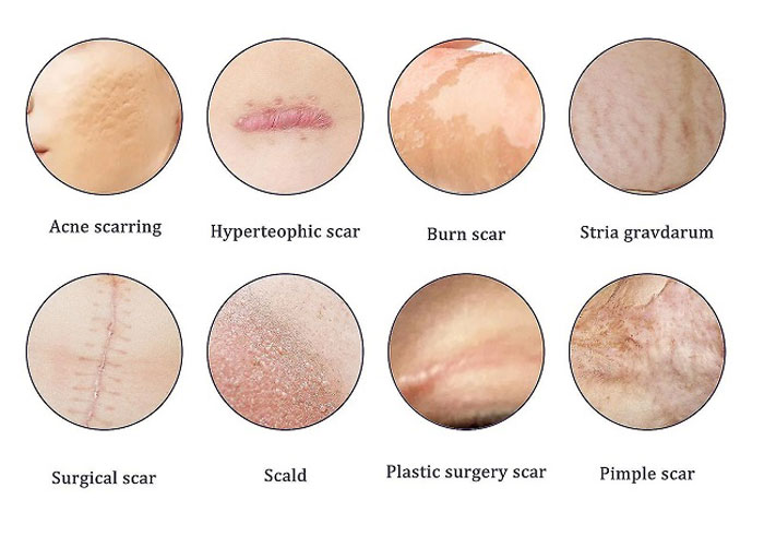 انواع-بافت-زخم