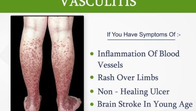 انواع زخم واسکولیت کدامند