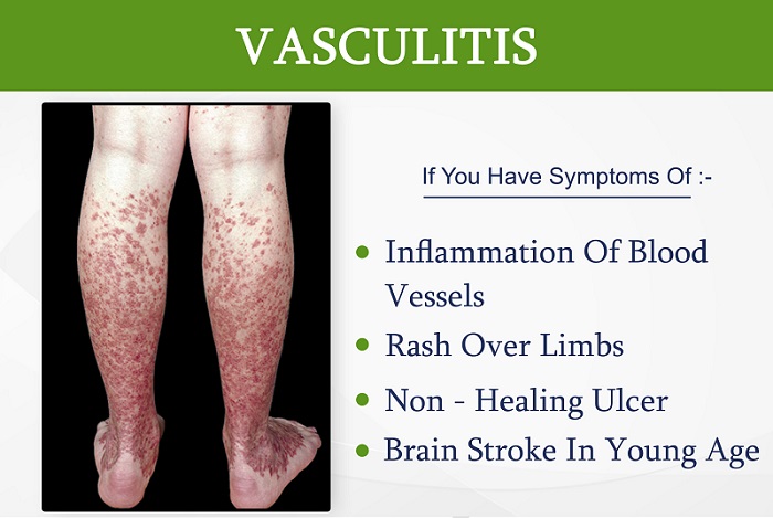 انواع زخم واسکولیت کدامند