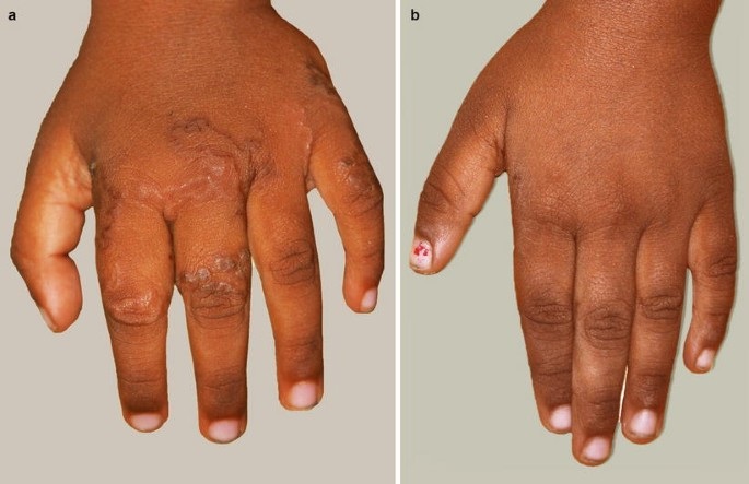 عفونت انگلی دارای چه علائمی است