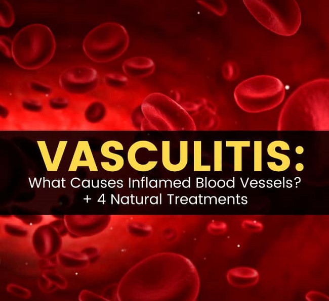 تشخیص زخم واسکولیتی چگونه است