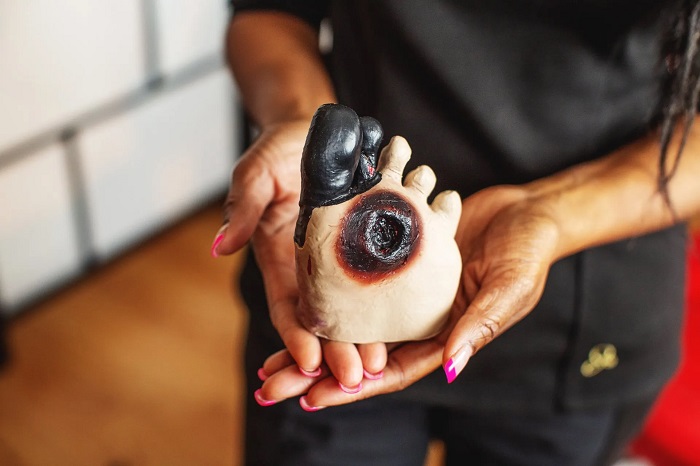 مراحل و روش های درمان سیاه شدن پای دیابتی