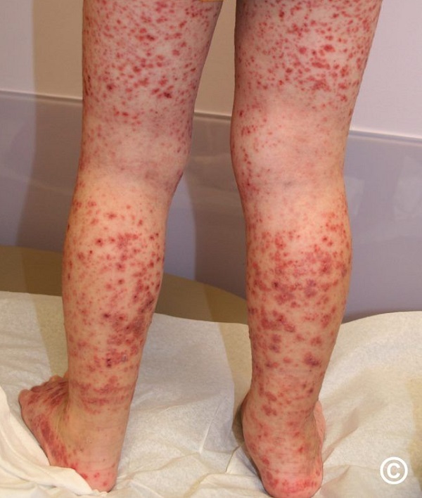 زخم واسکولیتی در کدام قسمت بدن بوجود می آید