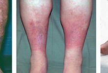 انواع التهاب زخم کدامند و چگونه بوجود می آیند