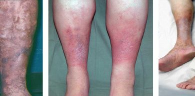 انواع التهاب زخم کدامند و چگونه بوجود می آیند