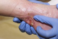 نحوه تشکیل ترشحات زخم چگونه است