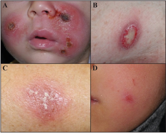 بیماری سالک