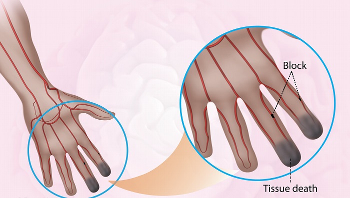 بیماری بورگر