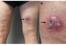 هیدرآدنیت چرکی چه علائمی دارد