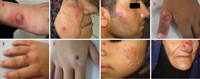 بیماری سالک