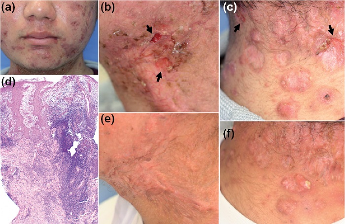 روش های تشخیص هیدرادنیت