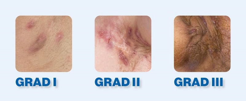 هیدرادنیت چرکی چه عوارضی دارد