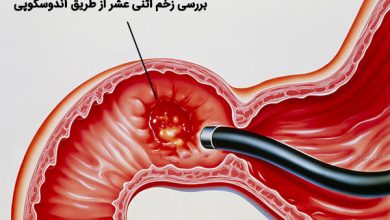 بررسی زخم اثنی عشر از طریق آندوسکوپی