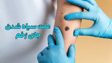 سیاه شدن جای زخم