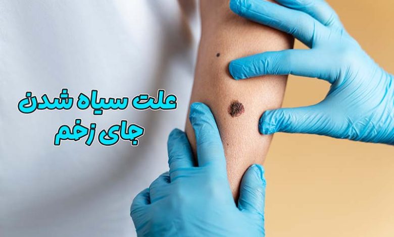 سیاه شدن جای زخم