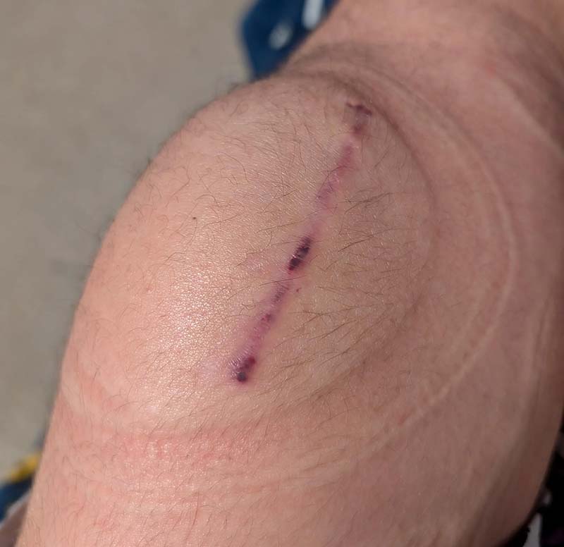 سیاه شدن جای زخم