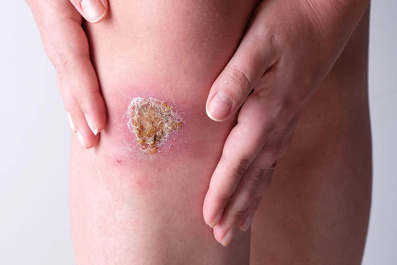 بهبود زخم چگونه انجام میشود