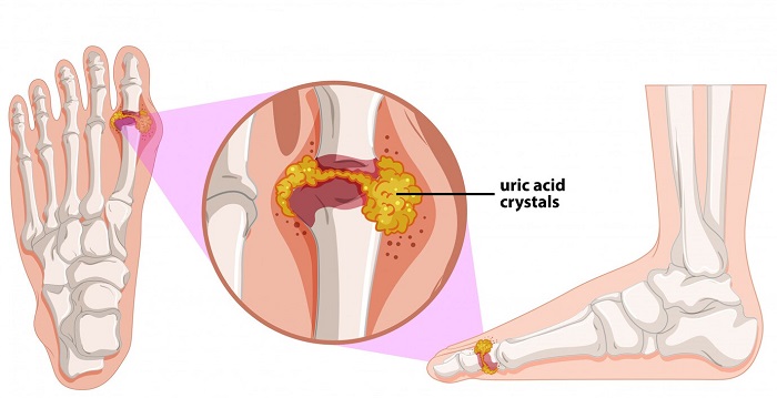 دلایل شایع عفونت استخوان کدامند