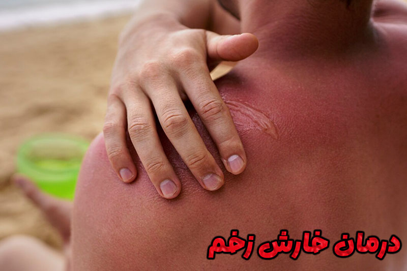 خارش زخم چیست و چه دلایلی دارد