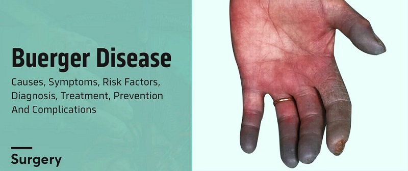 چه افرادی دچار بیماری بورگر میشوند چه افرادی دچار بیماری بورگر میشوند