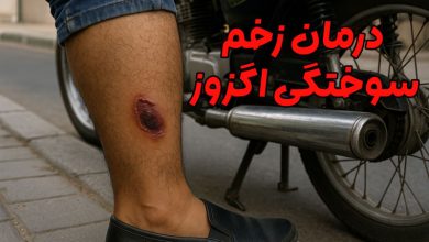 درمان زخم سوختگی اگزوز