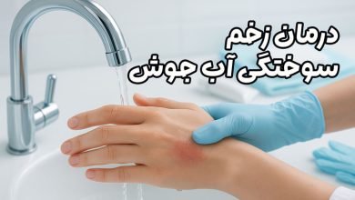 درمان زخم سوختگی آب جوش