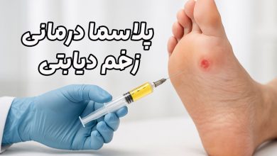 پلاسما درمانی زخم دیابتی