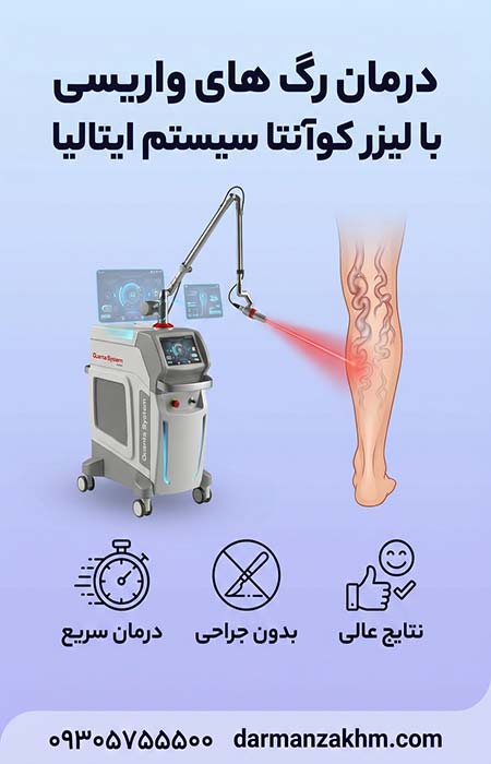 درمان-رگ-های-واریسی-با-لیزر-کوآنتا-سیستم-ایتالیا درمان رگ های واریسی با لیزر کوآنتا سیستم ایتالیا