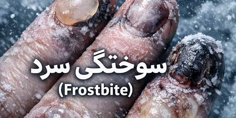 سوختگی سرد