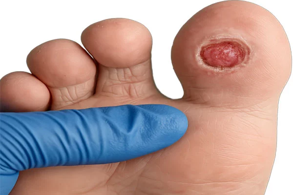 درمان حرفه‌ای زخم های دیابتی