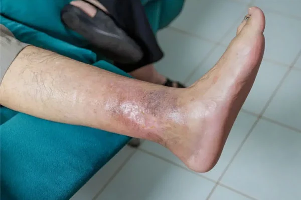 درمان سریع زخم های سوختگی شدید