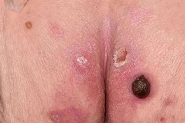 درمان قطعی زخم بستر