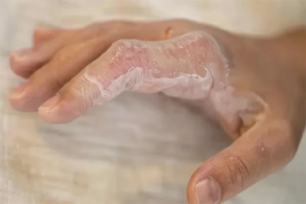 درمان سوختگی با آتش