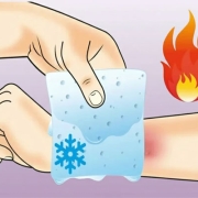 درمان سوختگی با آتش