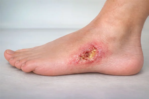 آشنایی-با-کلینیک-زخم-سوختگی-و-دیابتی-تجریش