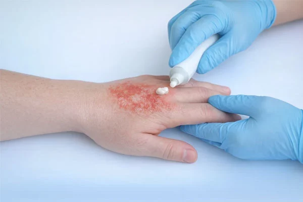 درمان-تخصصی-زخم-سوختگی-برای-ساکنین-منطقه-یک