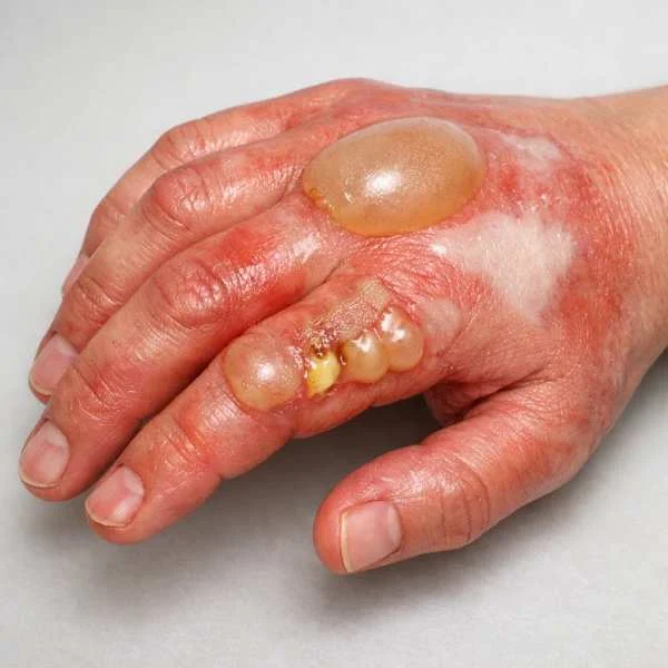 سوختگی خطرناک دست