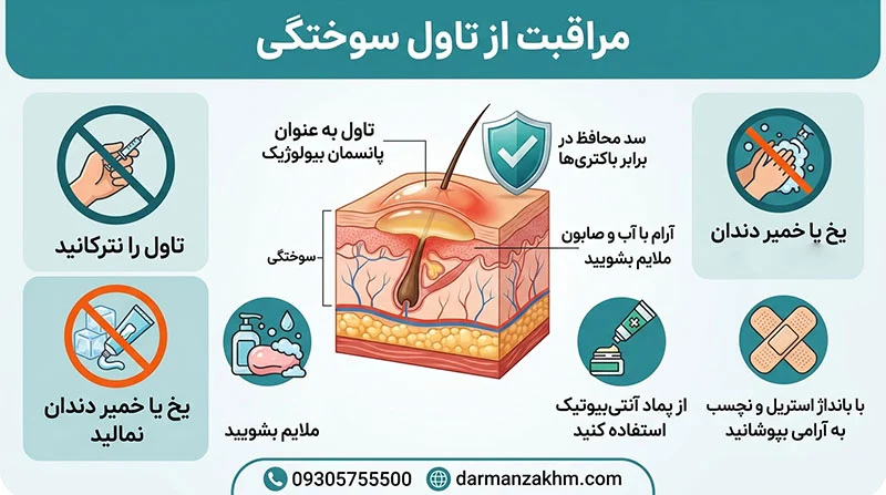 تاول سوختگی تاول سوختگی